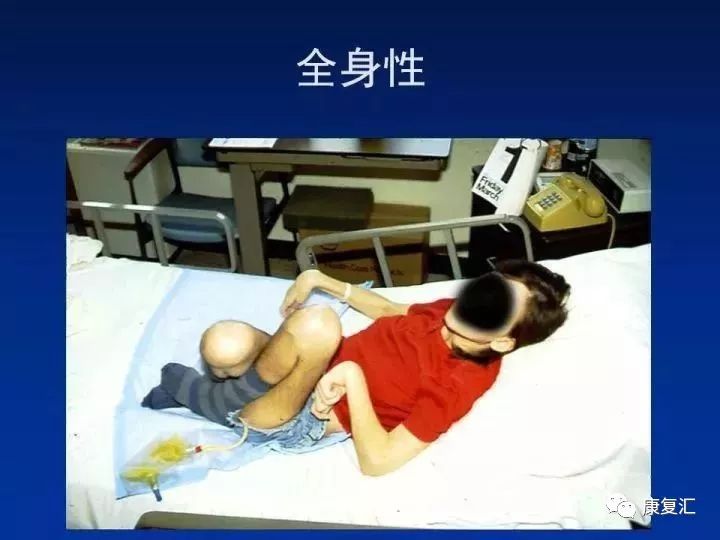 痉挛症可以治疗好吗,痉挛的康复