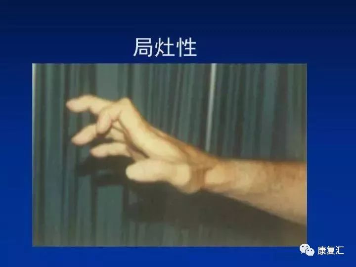 痉挛症可以治疗好吗,痉挛的康复