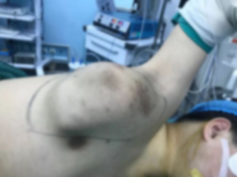 「风采」奋战12小时,河南省妇保院为男孩切除巨大瘤体!