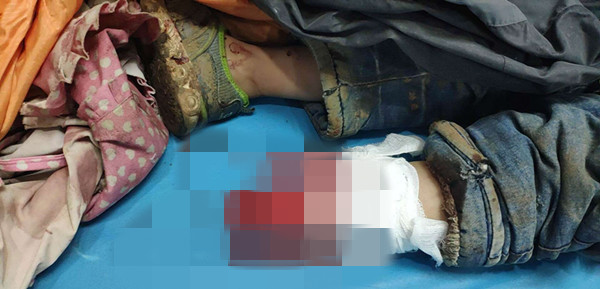 7小时断肢再植手术保住左小腿,左小腿断肢再植