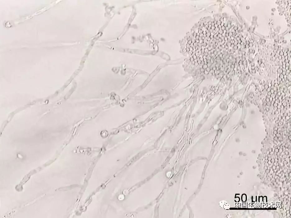 混合性痴呆致病因素,炎症会导致痴呆吗
