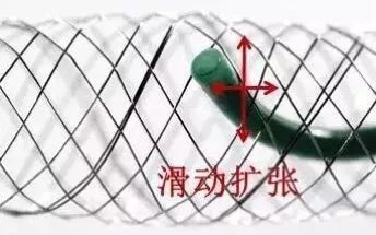 柳暗花明专栏|栓塞颅内动脉瘤时微导管无法穿过LVIS支架网眼怎么办