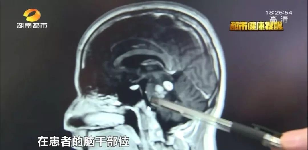 湖南一男子莫名全身乏力口齿不清，脑子里还有蠕动的……都是因为18年前吃了这个