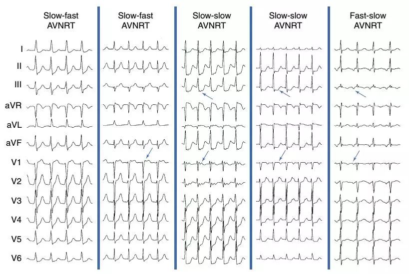 女孩无休止室上速?“真凶”样子有点“怪”!