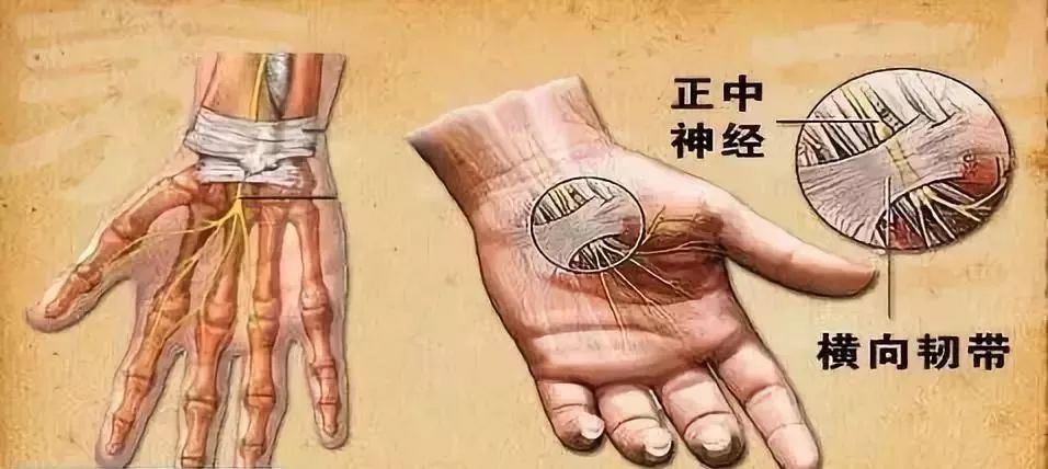 康复锻炼手麻是怎么回事,手麻的治疗思路这5个点要记住