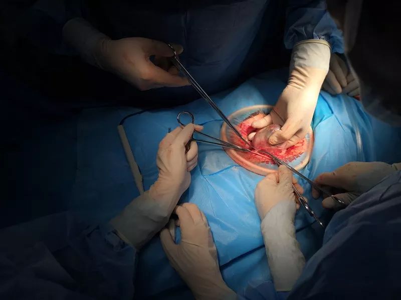 甘肃省中医院妇产科成功为一例肝硬化失代偿期并血小板减少的子宫出血合并卵巢囊肿患者实施手术