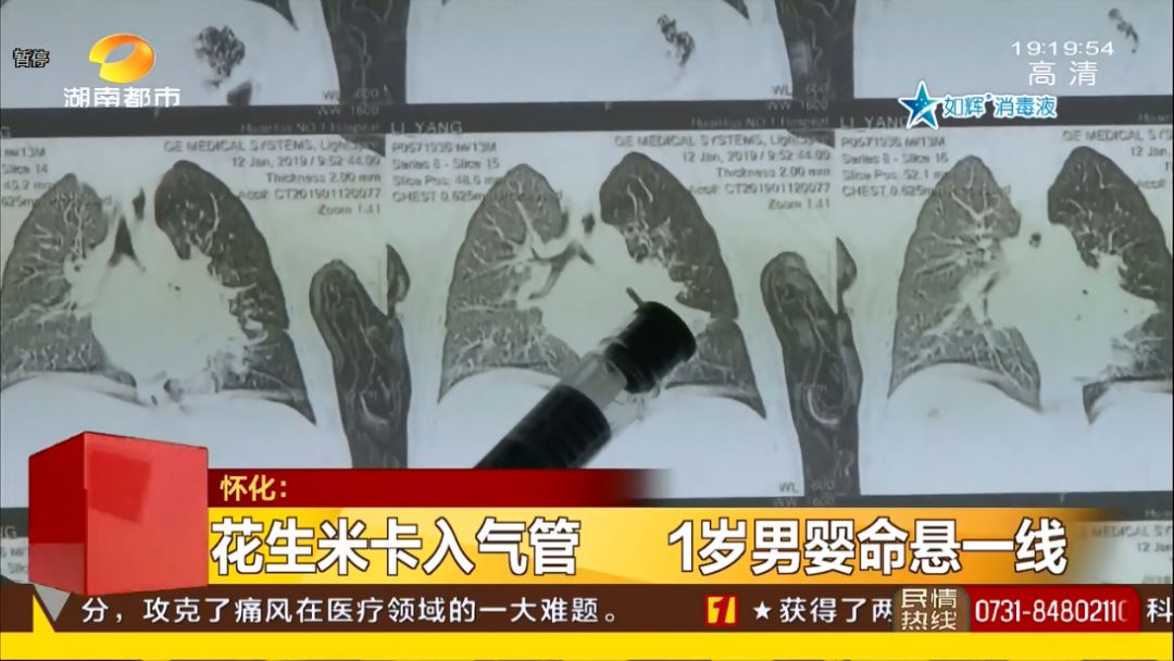 花生米卡入气管，1岁男婴命悬一线，送医院抢救，现已脱离了生命危险