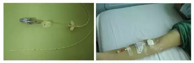 picc置管后我该如何维护,picc置管术后期维护要多少钱