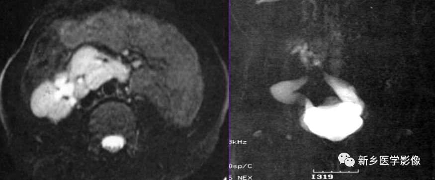 肾脏疾病鉴别五项意义,肾脏病理分型及临床表现