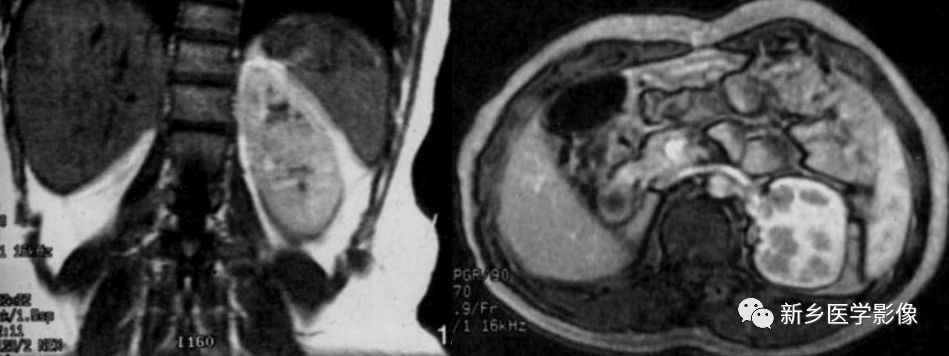 临床常见6种肾脏变异，鉴别诊断要点一览