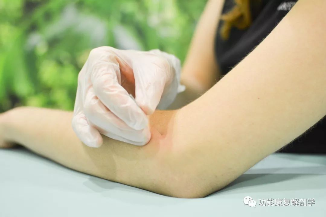 肱骨外上髁炎网球肘,网球肘肱骨外上髁炎如何按摩视频