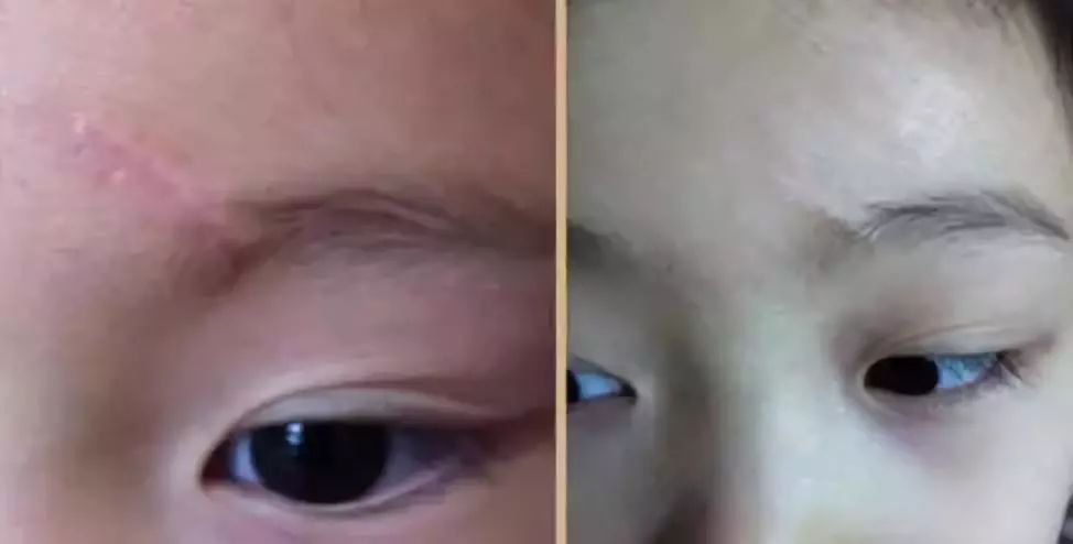 疤痕彻底消失新技术,疤痕淡化修复新技术