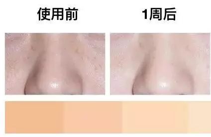 淡化痘印和斑点比较好的产品,美白淡化痘印产品真实测评