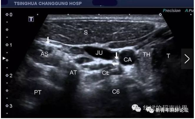 落枕了怎么办最快最有效方法,落枕了怎么办按什么穴位