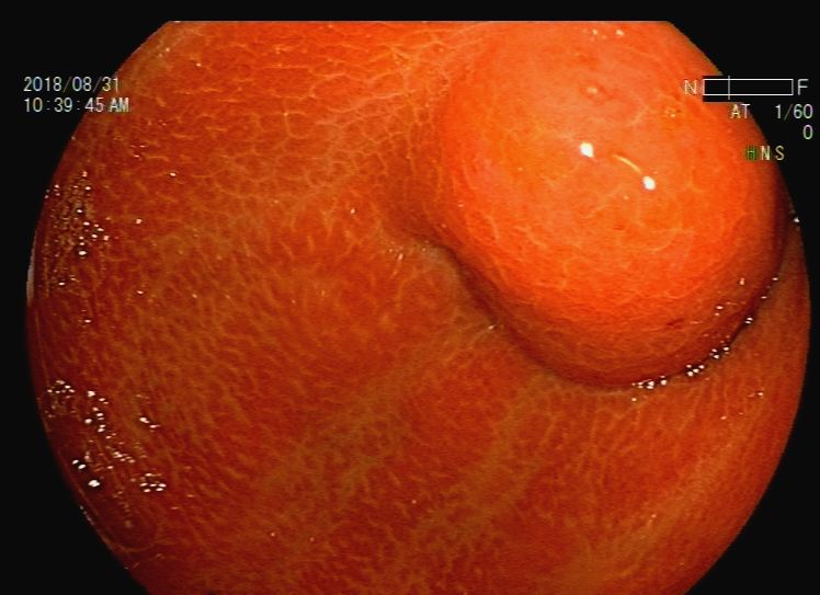 消化道支架置入术,消化道梗阻支架怎么放