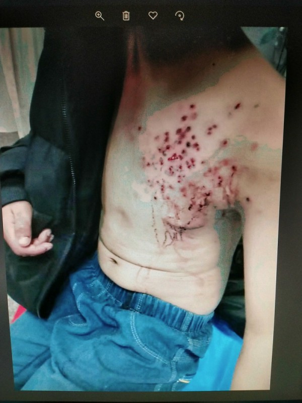 十三岁男孩被火炮爆伤,小孩被枪打中后脑