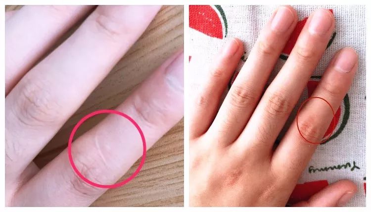 疤痕体质如何去痘印和烫伤印,烫伤色素疤痕修复的最新方法