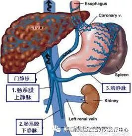 脾动脉栓塞术,脾栓塞手术的适应症