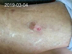 热水袋烧伤,热水袋烧伤起泡怎么处理