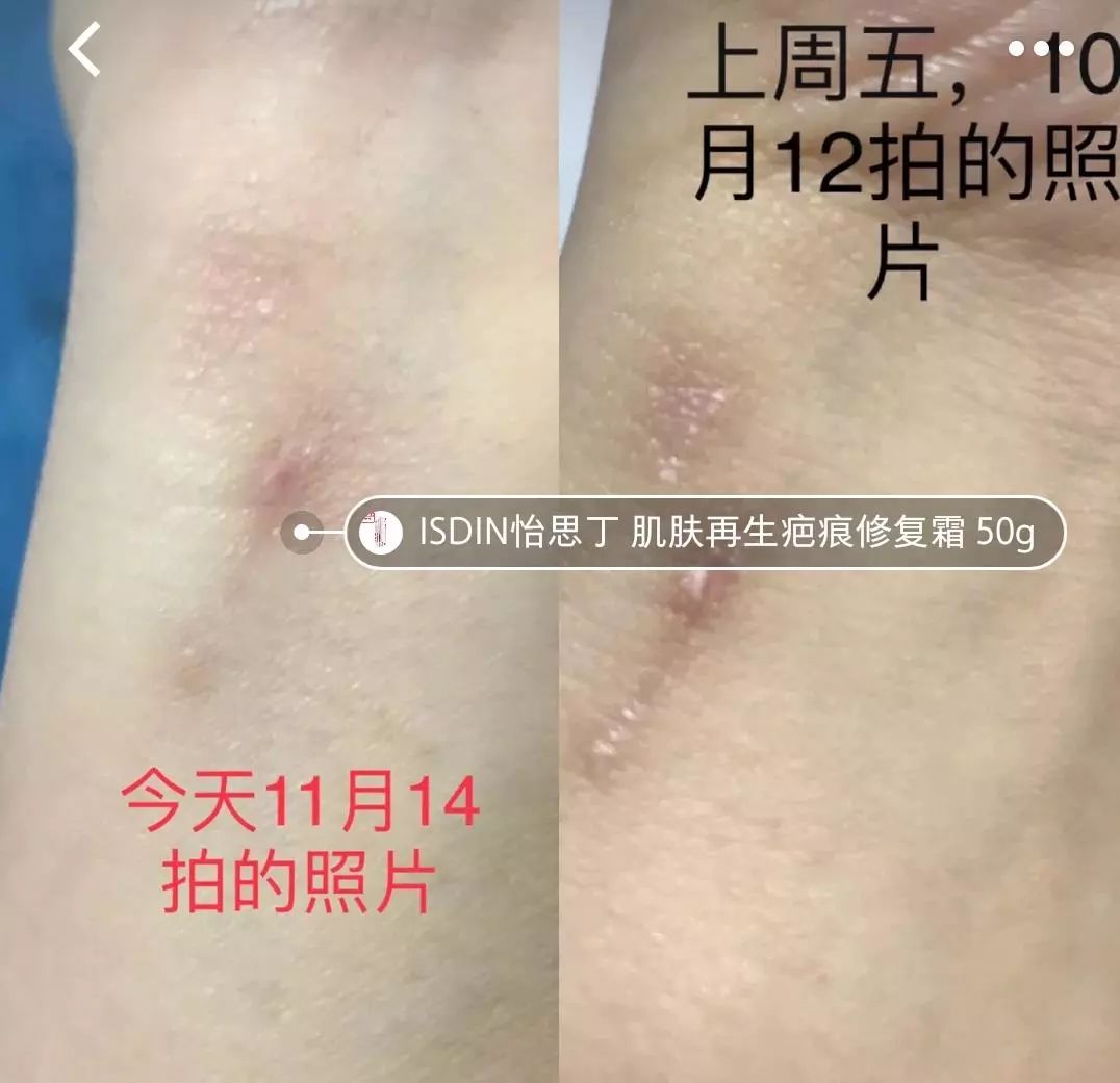 疤痕体质如何去痘印和烫伤印,烫伤色素疤痕修复的最新方法