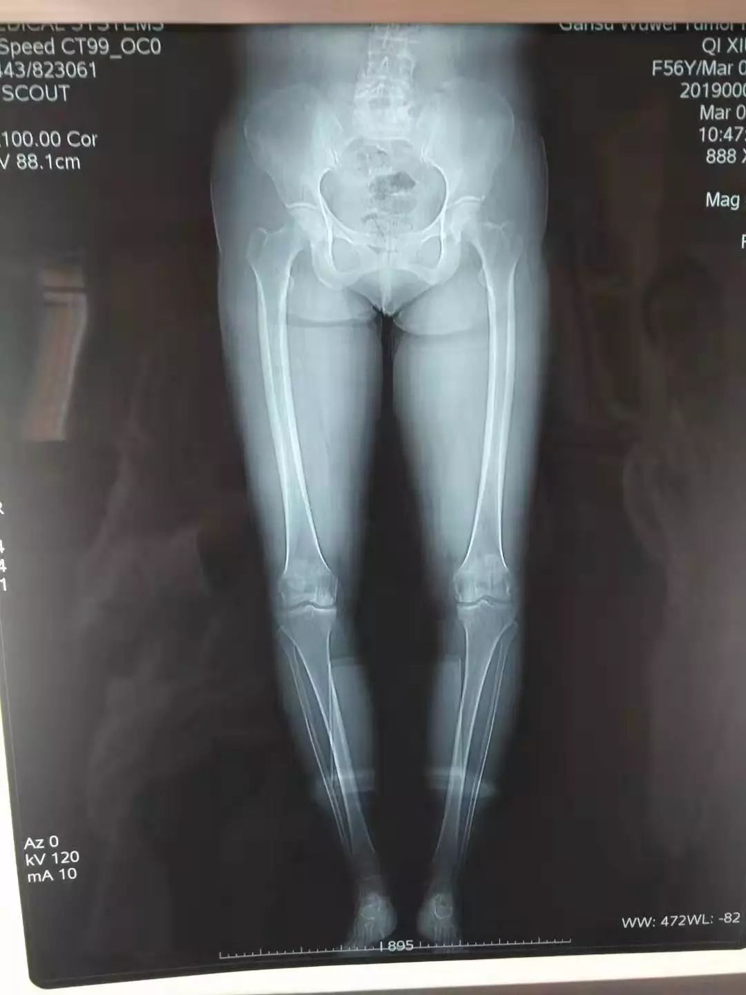 胫骨高位截骨术的适应症,胫骨截骨术hto是微创吗