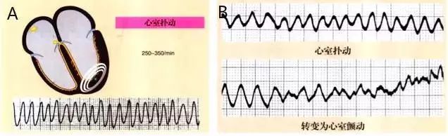 常见心律失常的识别和处理,心衰合并恶性心律失常的治疗策略