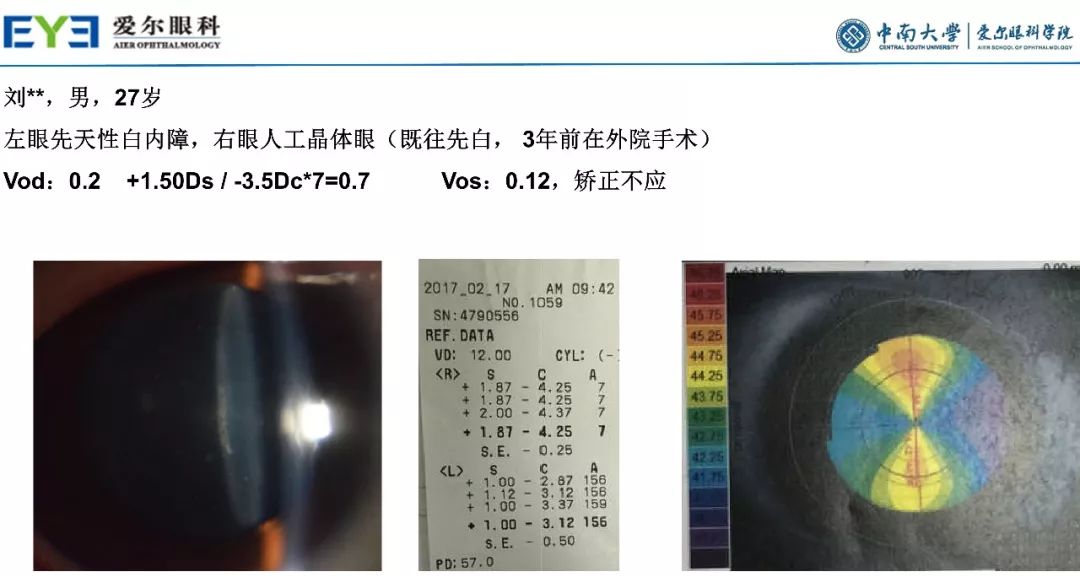 大师讲堂预告丨连续视程白内障手术治疗散光的关键要点-公式选择和手术松解要点