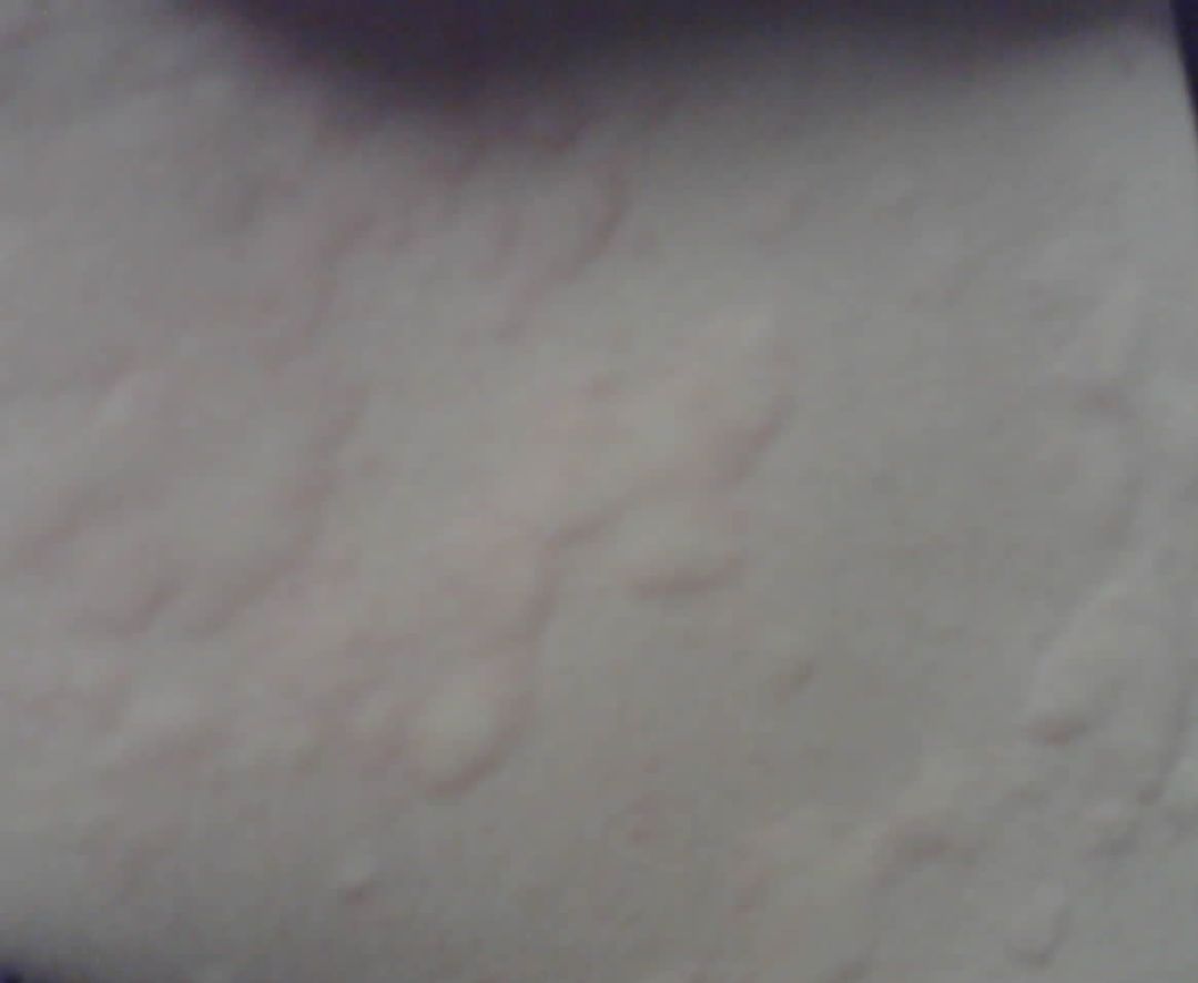 单氏中医治荨麻疹,中医治疗日光荨麻疹的最好方法