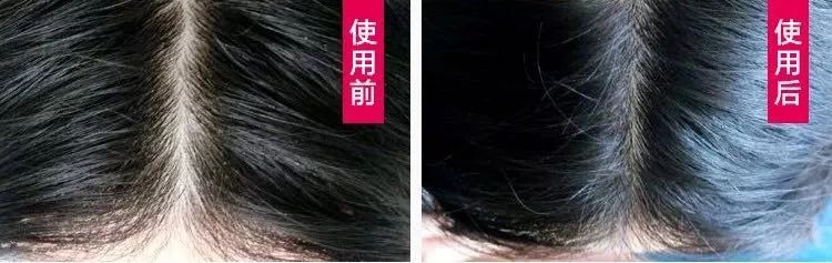 发际线防脱发神器,增发神器发际线