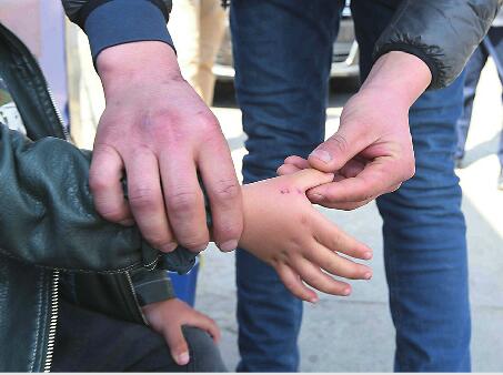 孩子被老鼠咬到怎么处理,孩子被老鼠咬成了这样