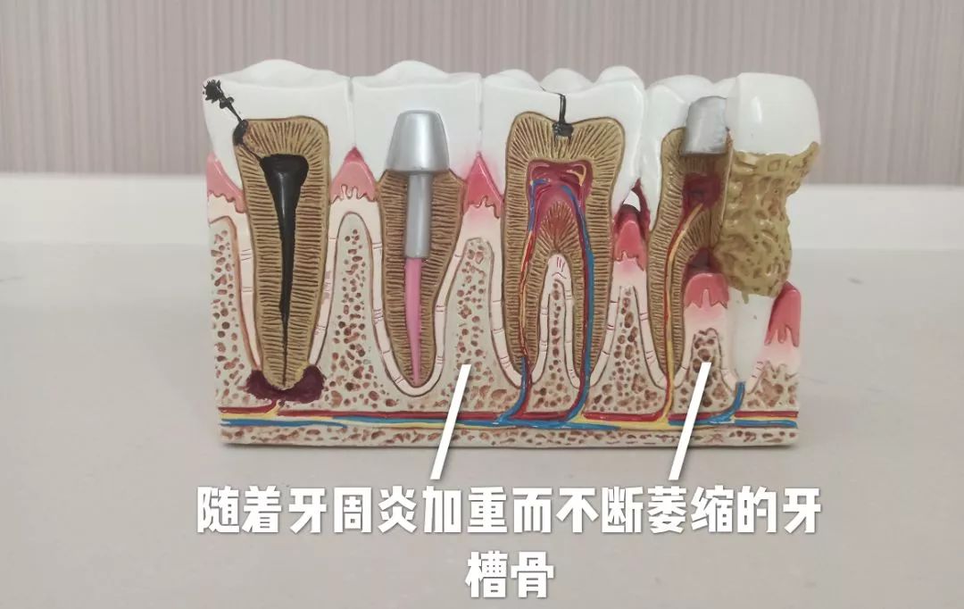 洗牙后牙缝变大了能自然恢复吗,健康洁牙和洗牙