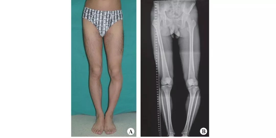 taylorswift支架,taylor外固定支架