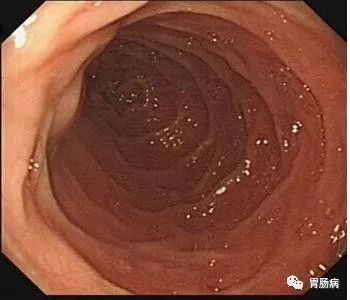 容易癌变的息肉有哪些,什么样子的息肉容易癌变