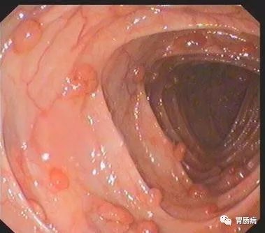 容易癌变的息肉有哪些,什么样子的息肉容易癌变