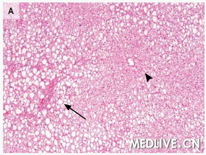 急性肝功能衰竭死亡病例,急性肝功能衰竭能彻底治好吗