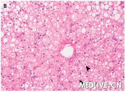 急性肝功能衰竭死亡病例,急性肝功能衰竭能彻底治好吗