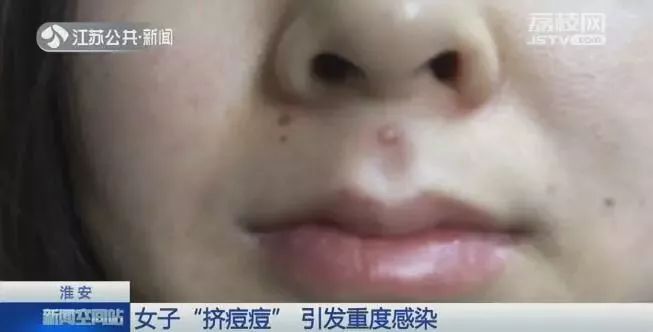 女子挤痘痘致感染被送急诊,女子挤痘痘进icu