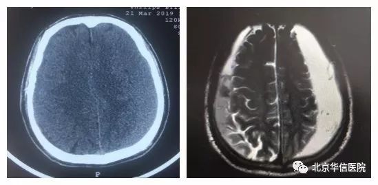 头部外伤后慢性硬脑膜下血肿,老人外伤引起颅内血肿症状表现