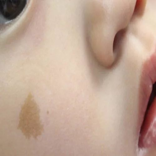 孕妇有咖啡斑会遗传给宝宝吗,孕妇喝咖啡胎儿会长斑吗