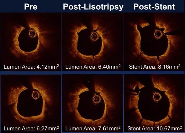 oct閽欏寲鐥呭彉,cit2019灞曚細瑙嗛