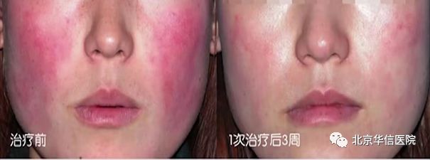 全国皮肤激光美容规范化培训学习,皮肤美容激光项目培训内容