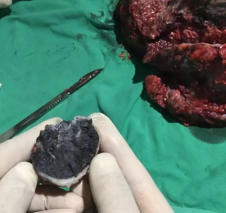 职业健康宣传周之尘肺病防治,职业病尘肺病防治措施