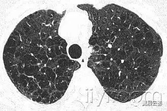 胸部解剖及常见疾病影像表现,胸部影像学基础知识