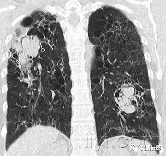 胸部解剖及常见疾病影像表现,胸部影像学基础知识