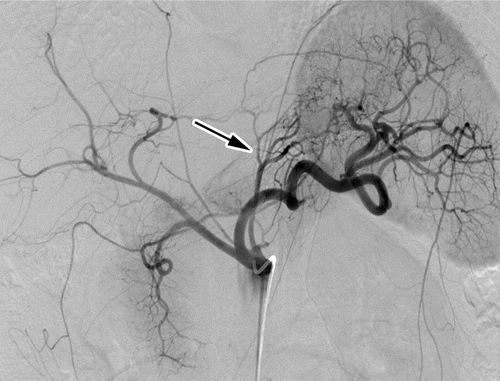 胃底动脉栓塞手术减肥费用,胃左动脉栓塞减肥哪里可以做