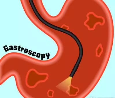 预防胃肠癌从做胃肠镜开始,胃肠镜检查早癌