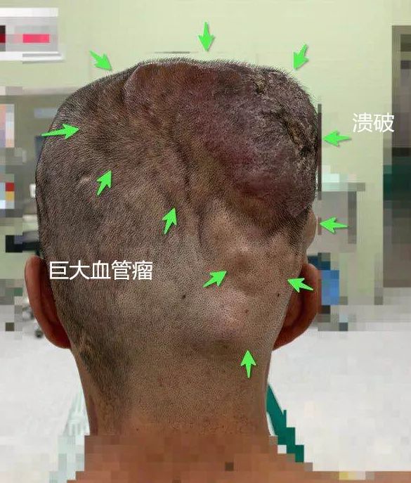 清华长庚医院混合瘤,清华长庚血管外科