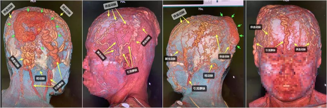清华长庚医院混合瘤,清华长庚血管外科