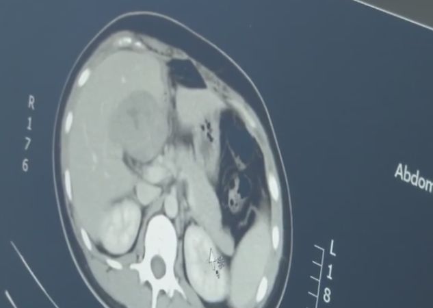 女子怀孕子宫破了,女子怀孕却发现肚子里是20斤肿瘤