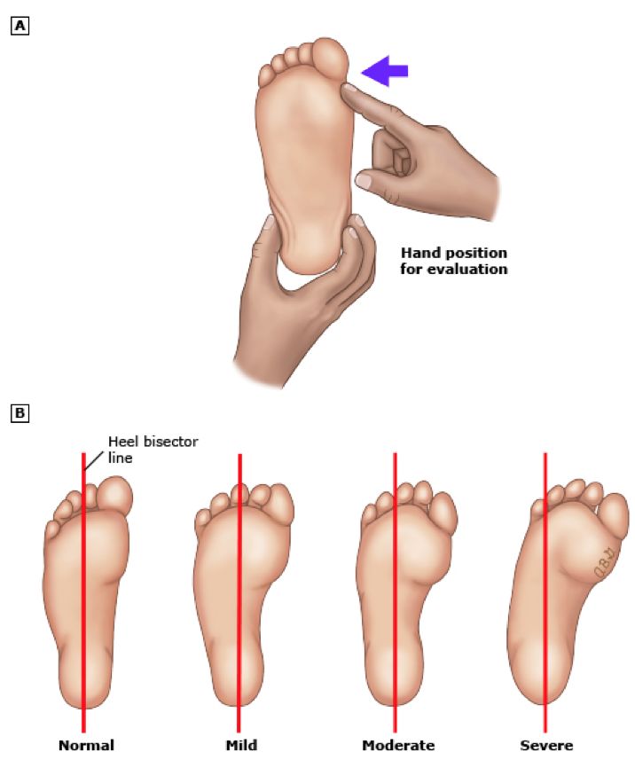 如何辨别孩子走路内八字,走路内八字和外八字